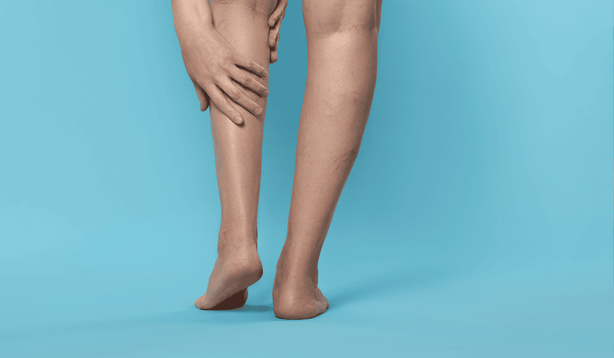 Żyłki na nogach mogą świadczyć o poważnym problemie