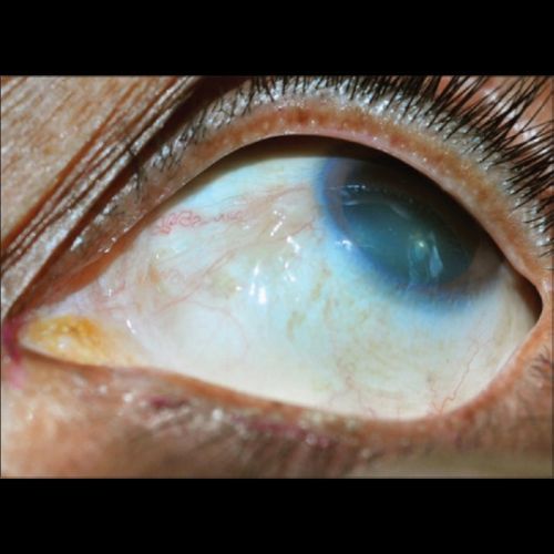 Rogowacenie słoneczne Fot. Honavar SG, Manjandavida FP. Tumors of the ocular surface A review. Indian J Ophthalmol. 2015;63(3)187–203. Licencja CC BY-NC-SA 3.0..jpg