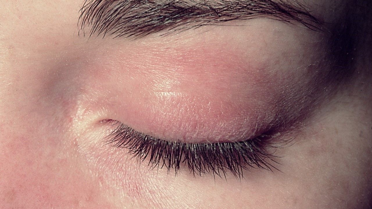 Gdy zaczyna się rak żołądka, zmienia się skóra. Jeśli zauważysz takie zmiany, biegnij do lekarza