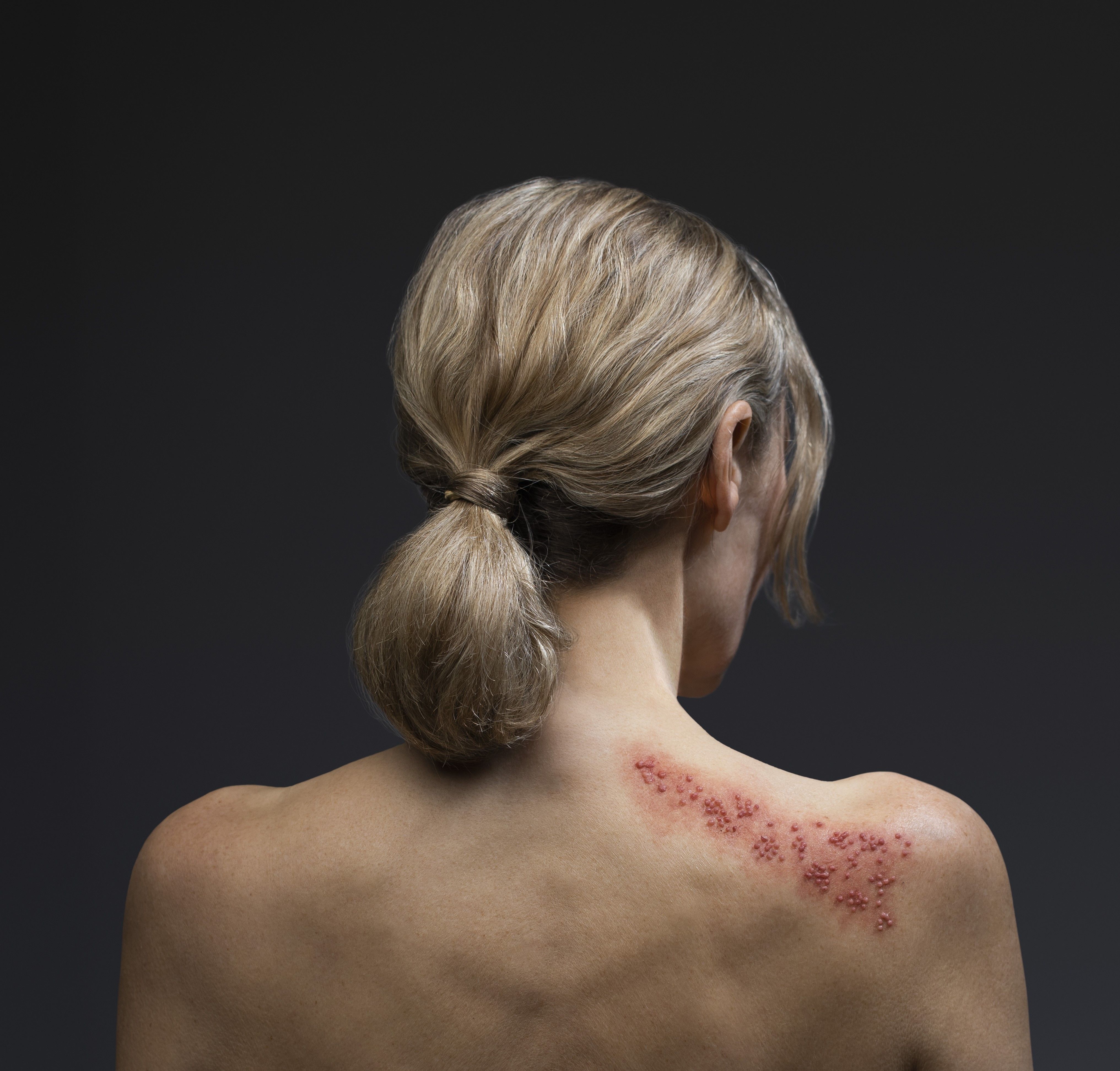 Półpasiec: choroba, która czai się w Twoim organizmie.