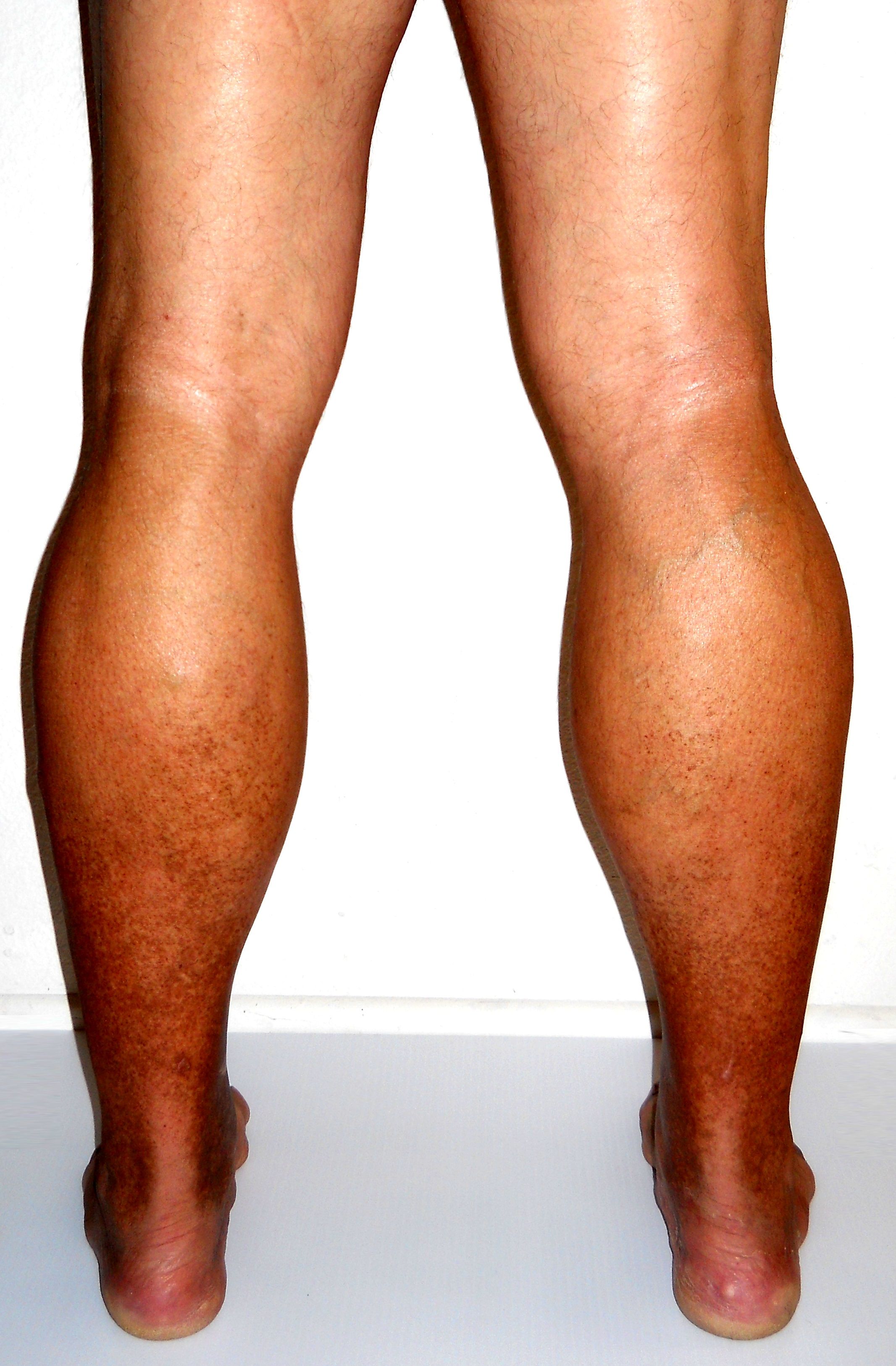 Spójrz na swoje kostki. Ten jeden szczegół zdradza stan Twoich żył