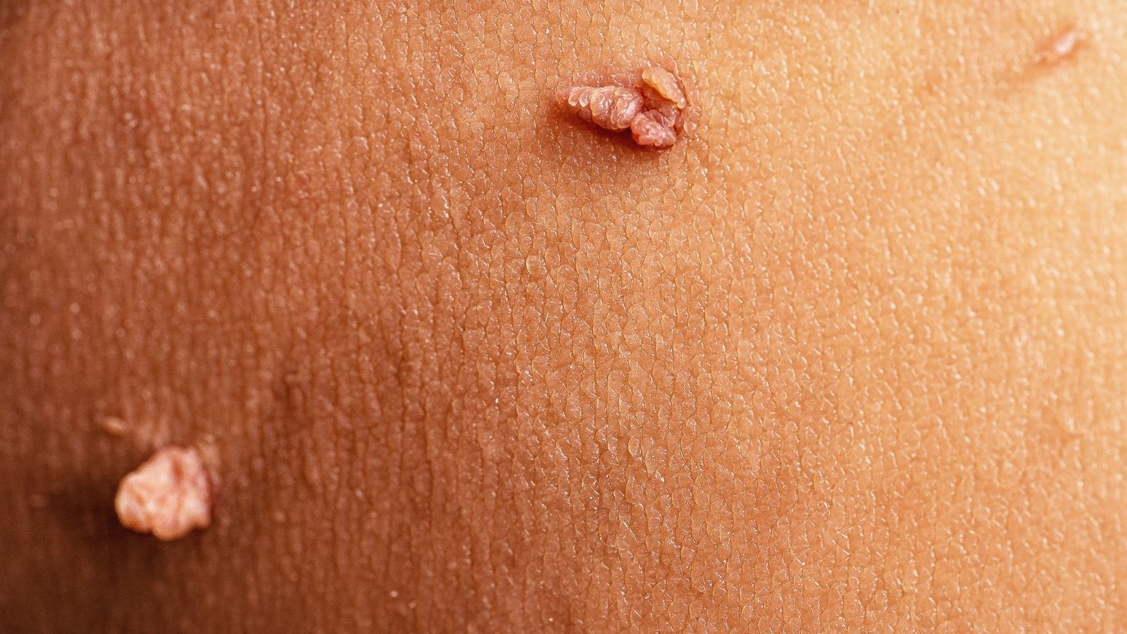 Włókniaki na skórze – co mogą sygnalizować i kiedy zgłosić się do lekarza?