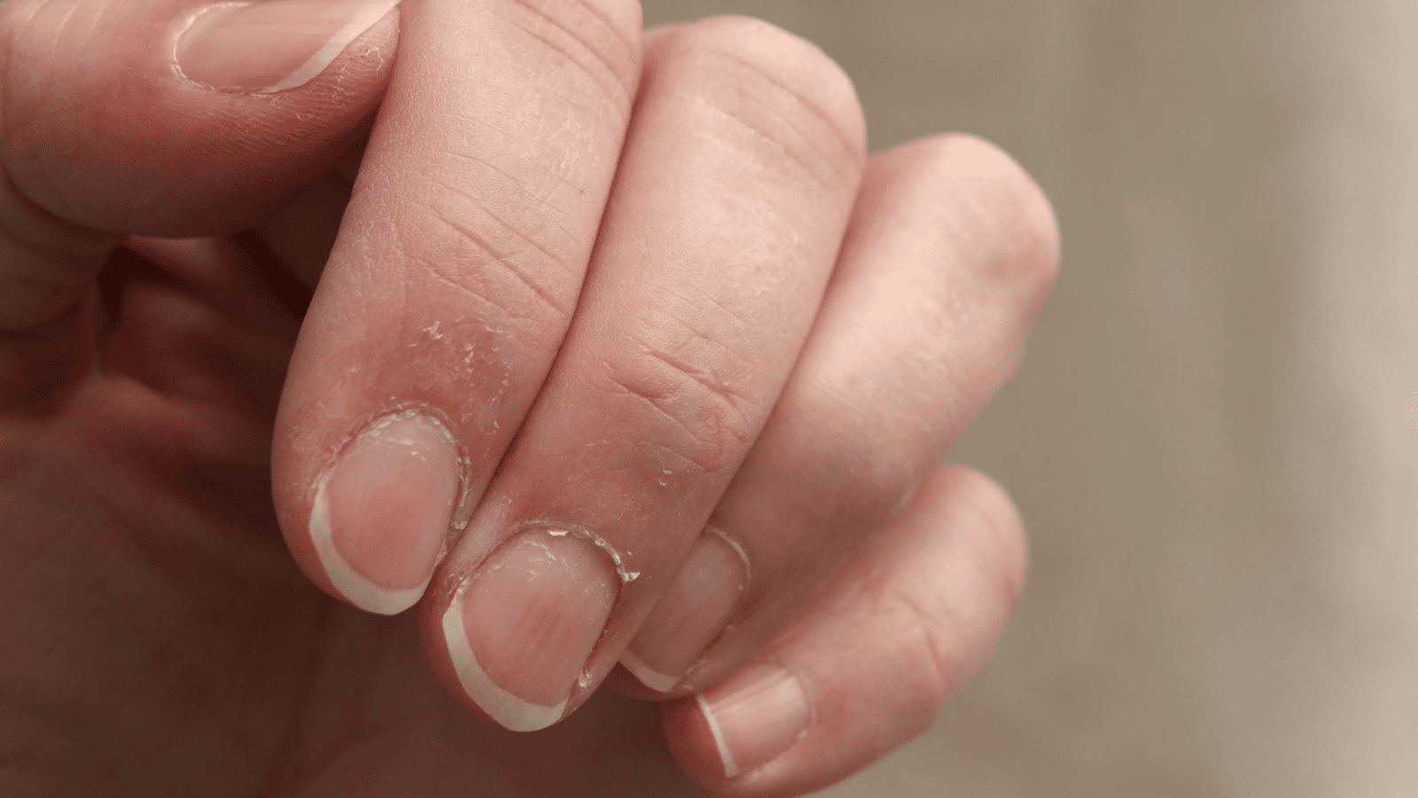 Skórki zadzierają się nie tylko od wysuszenia czy zimna. Tak może się objawiać poważny niedobór