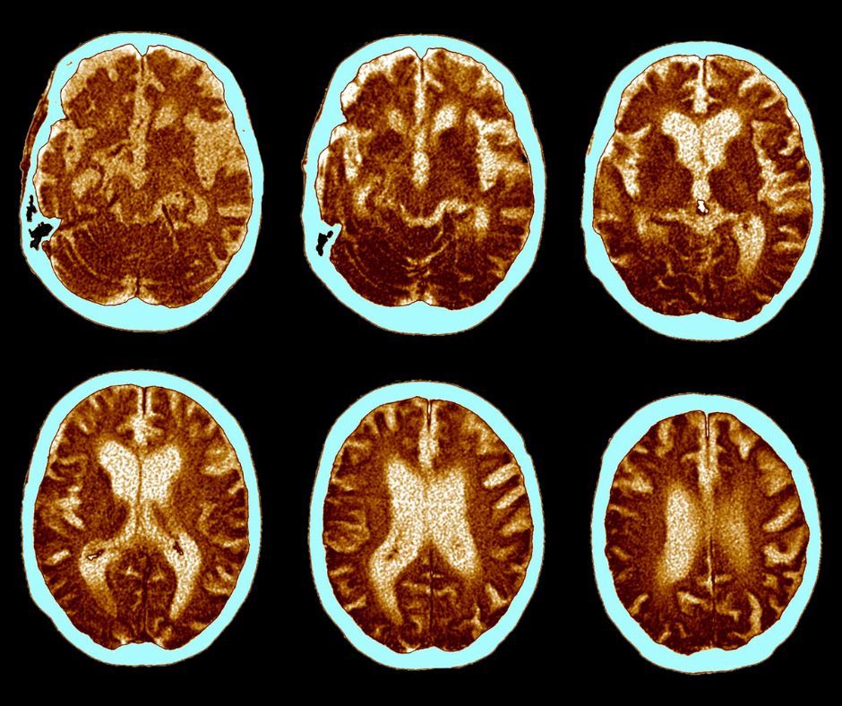Zmiany neurologiczne w mózgu przy chorobie Alzheimera