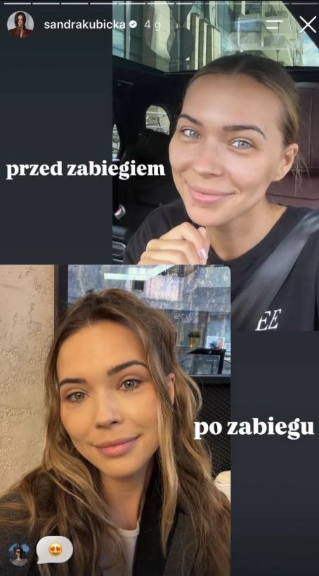 Tak wygląda Sandra Kubicka 20 dni po operacji powiek. Wydała komunikat