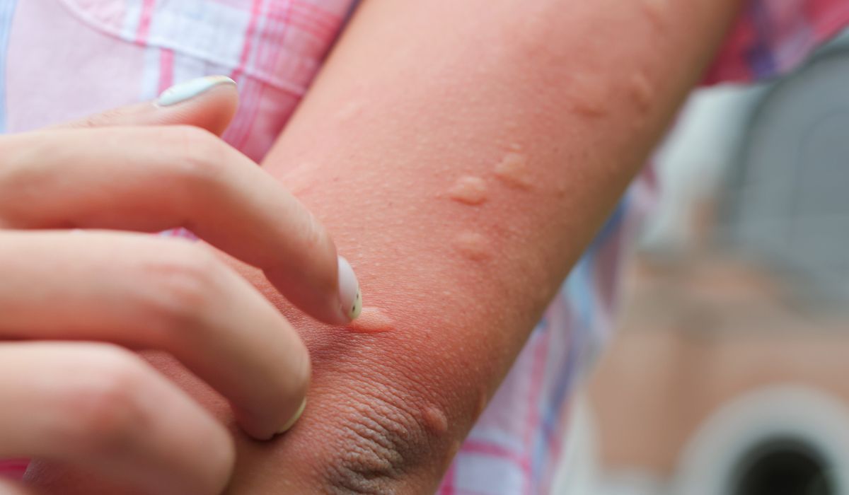 groźna choroba zakaźna, ONZ alarmuje