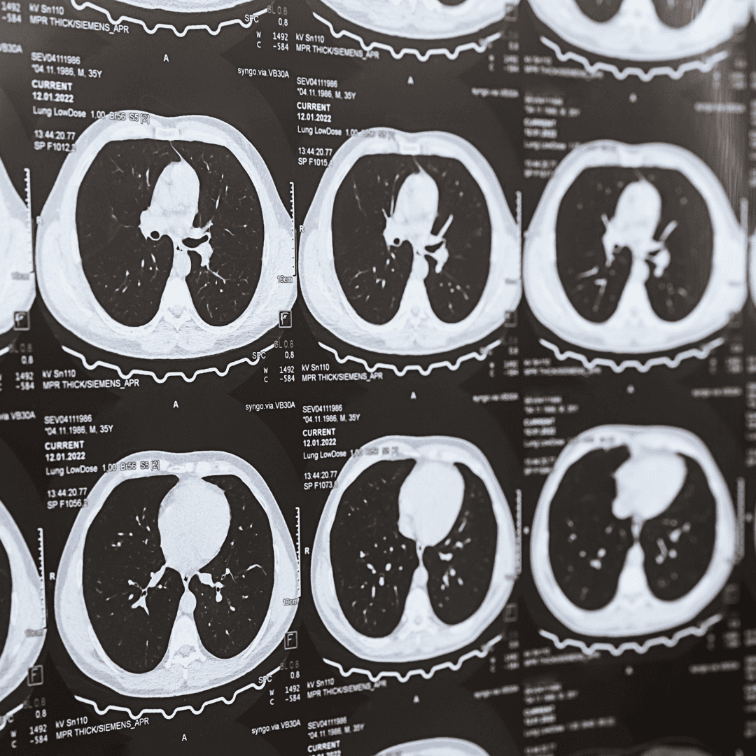 Rak płuca: darmowa tomografia od 1 października. Zobacz zasady programu