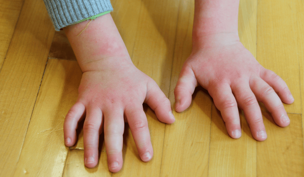 czerwone ręce u dziecka