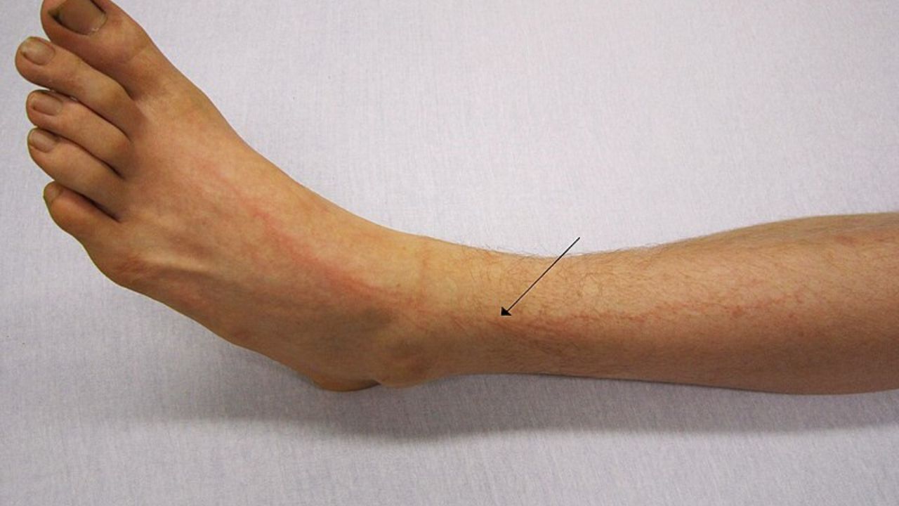 figury Lichtenberga Fot. James Heilman, MD - Own work CC BY-SA 3.0.jpg