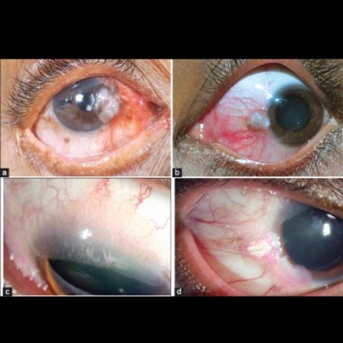 guzy oka Fot. Honavar SG, Manjandavida FP. Tumors of the ocular surface A review. Indian J Ophthalmol. 2015;63(3)187–203. Licencja CC BY-NC-SA 3.0..jpg