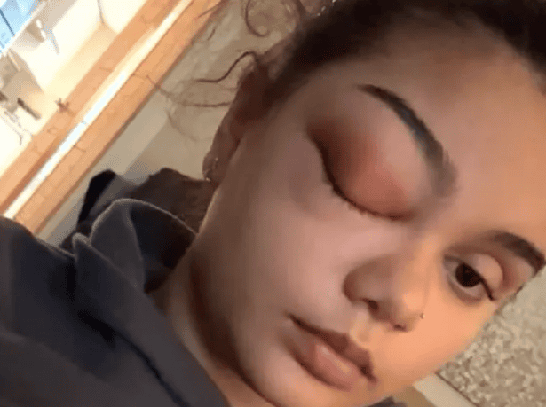 Zapalenie zatok objęło mózg. Nastolatka niemal straciło oko