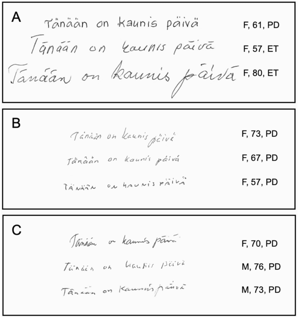 Taki charakter pisma może wskazywać na groźną chorobę. Jeśli tak piszesz, biegnij do neurologa