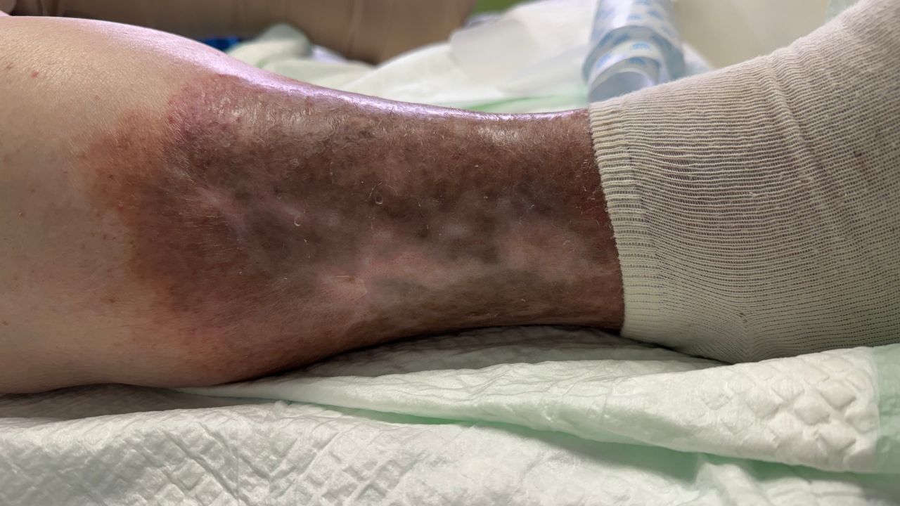 „Najważniejsza jest kompresjoterapia”. Ekspert o owrzodzeniach żylnych