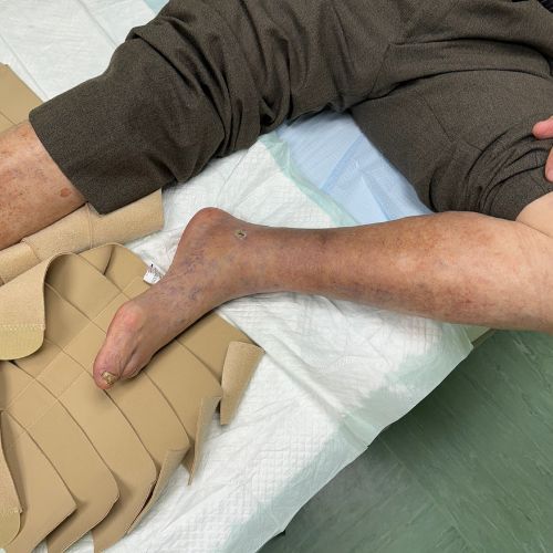 „Najważniejsza jest kompresjoterapia”. Ekspert o owrzodzeniach żylnych