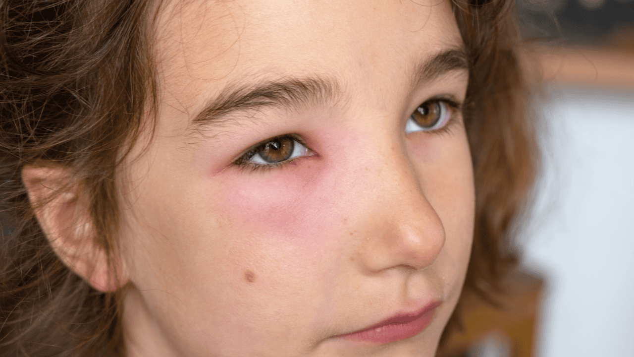 Objawy chorych nerek widoczne na twarzy. Nigdy ich nie ignoruj