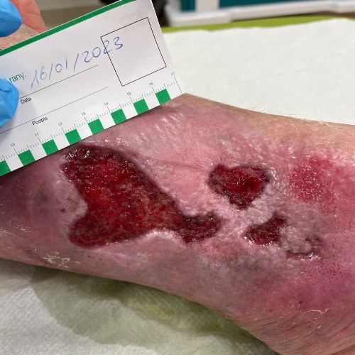 „Najważniejsza jest kompresjoterapia”. Ekspert o owrzodzeniach żylnych