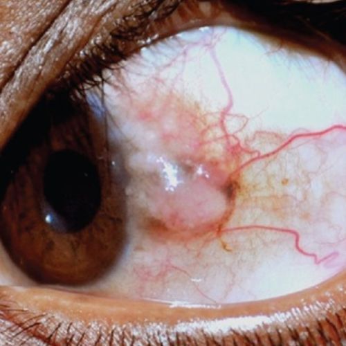 przerost pseudonabłonkowy Fot. Honavar SG, Manjandavida FP. Tumors of the ocular surface A review. Indian J Ophthalmol. 2015;63(3)187–203. Licencja CC BY-NC-SA 3.0..jpg