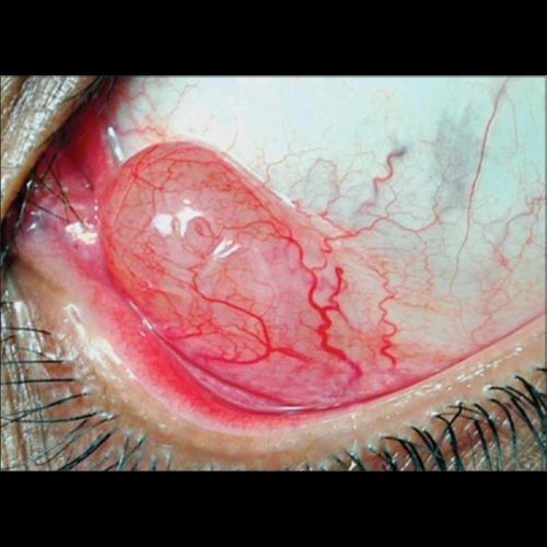torbiel wtrętowa spojówki Fot. Honavar SG, Manjandavida FP. Tumors of the ocular surface A review. Indian J Ophthalmol. 2015;63(3)187–203. Licencja CC BY-NC-SA 3.0..jpg