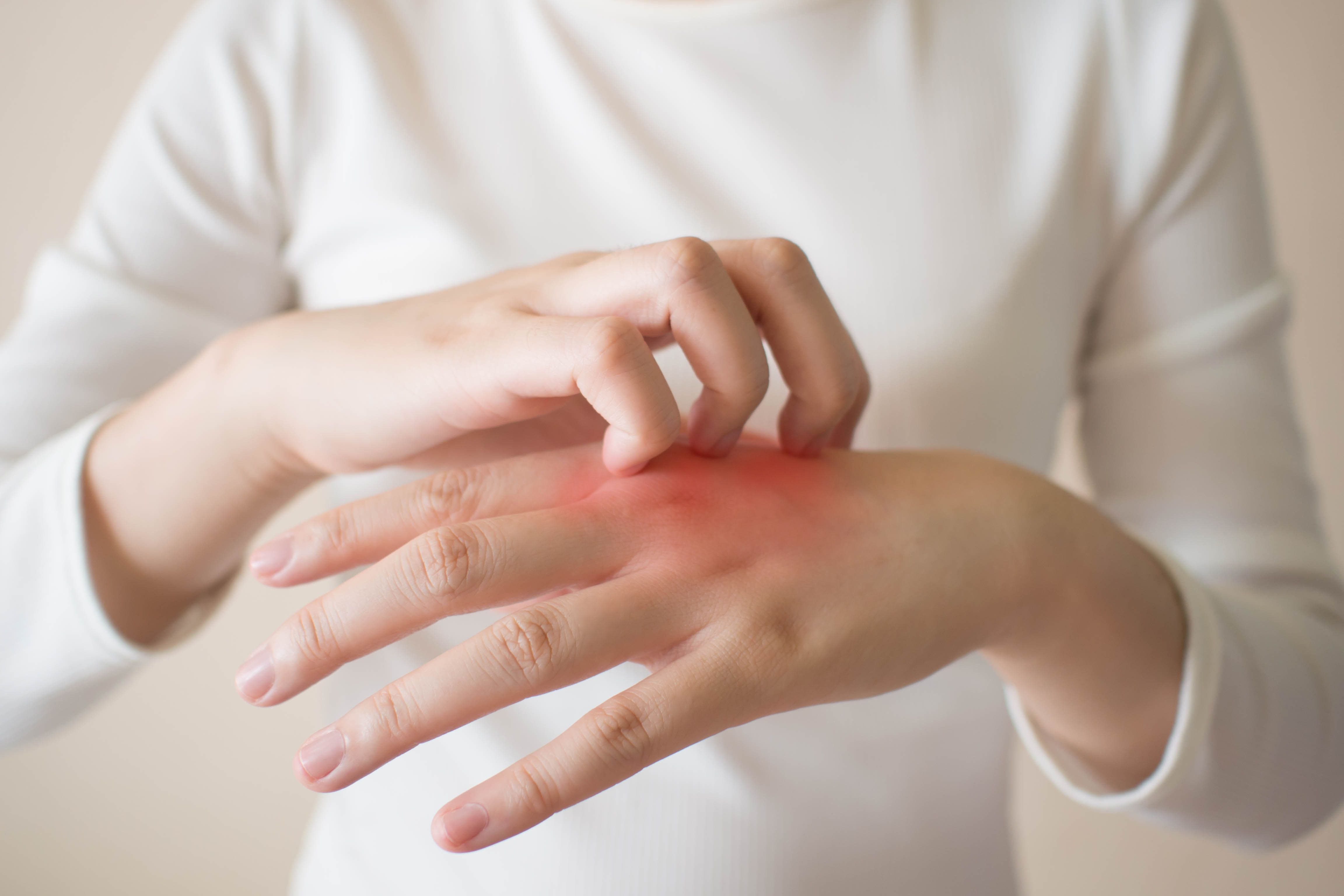 Nabyty rumień dłoni i stóp – przyczyny, diagnostyka, leczenie