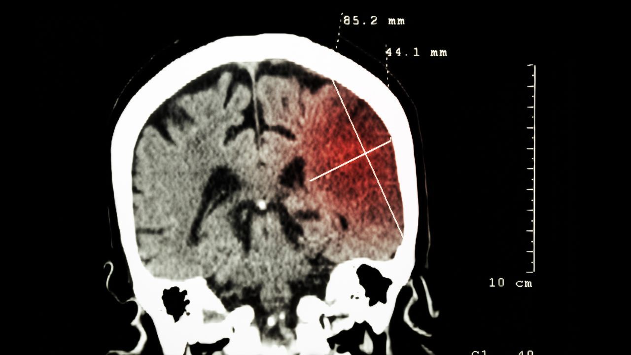 Wysyp udarów przed 50 r.ż. Jakie są przyczyny?