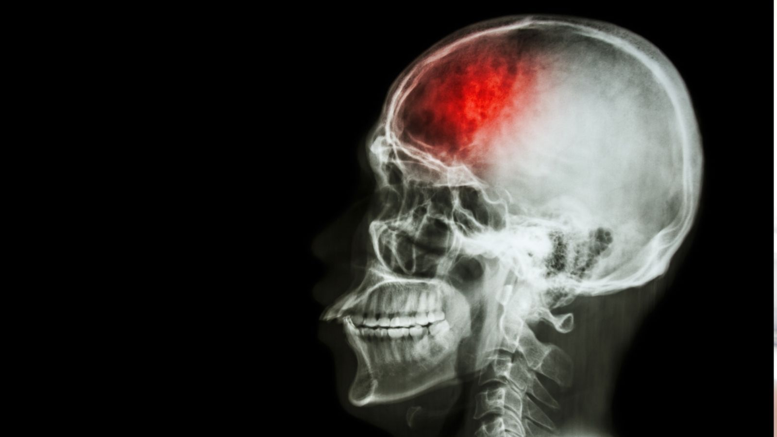 Udar u młodych dorosłych – rosnący trend, o którym mówi coraz więcej badań