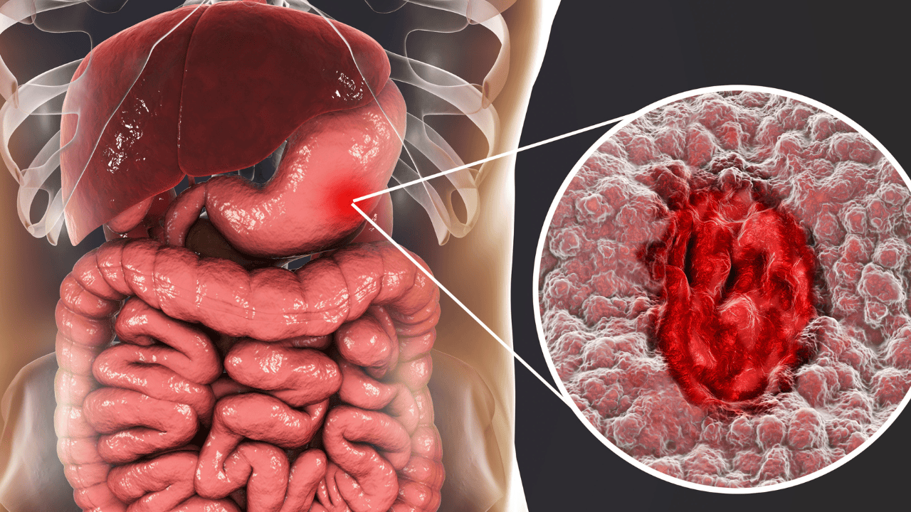Objawy wrzodów żołądka. Nieleczone mogą zagrażać życiu