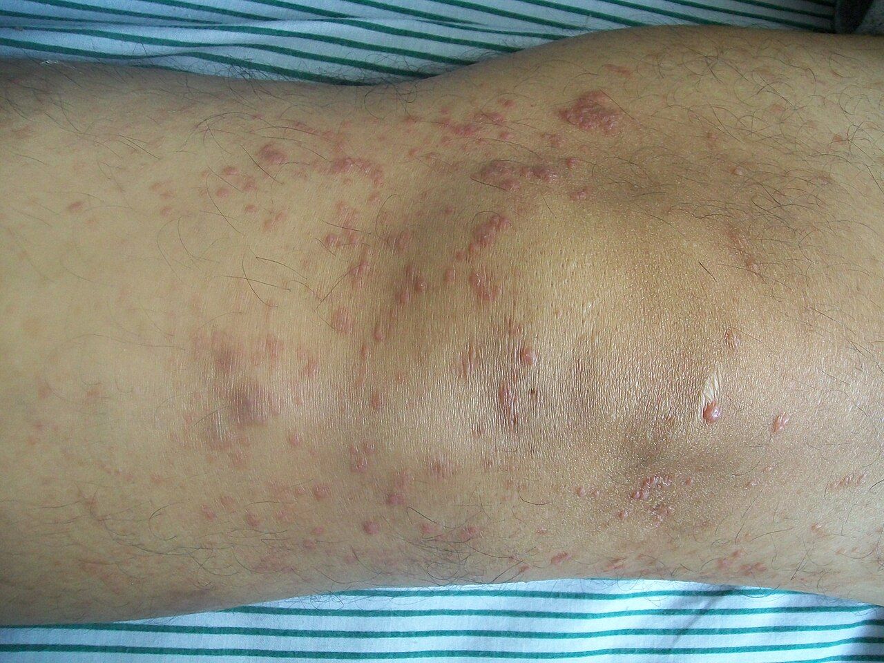 Nietypowe zmiany skórne a nowotwory złośliwe. Dermatolodzy ostrzegają przed tymi objawami