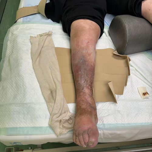 „Najważniejsza jest kompresjoterapia”. Ekspert o owrzodzeniach żylnych